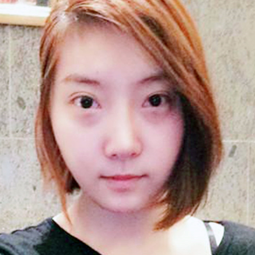 米蘭柏羽做了外切去眼袋，分享手術(shù)前后對(duì)比果圖片哦~