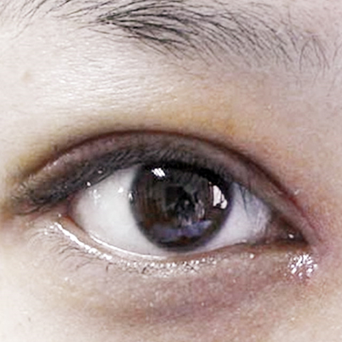 米蘭柏羽做了外切去眼袋，分享手術(shù)前后對(duì)比果圖片哦~