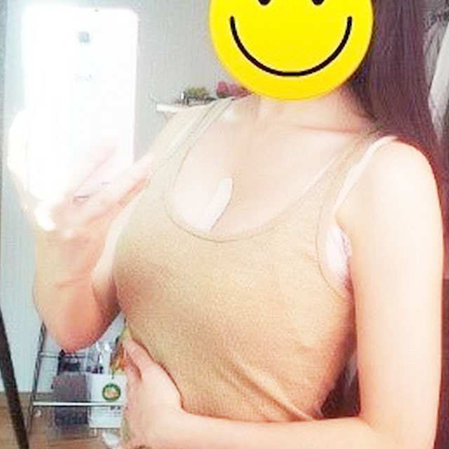 自體脂肪移植隆胸恢復(fù)過程和前后對(duì)比果圖片分享哦~