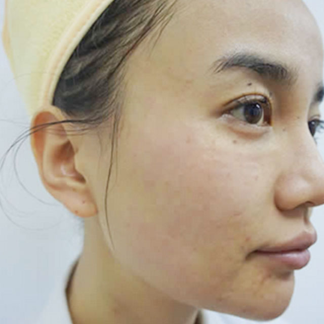 分享我的光子嫩膚經(jīng)歷，還有前后對(duì)比果照片哦~