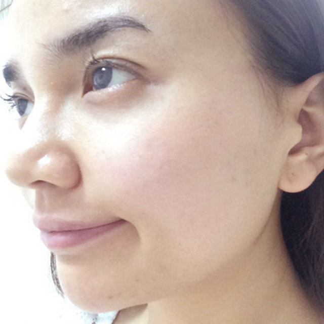 分享我的光子嫩膚經(jīng)歷，還有前后對(duì)比果照片哦~