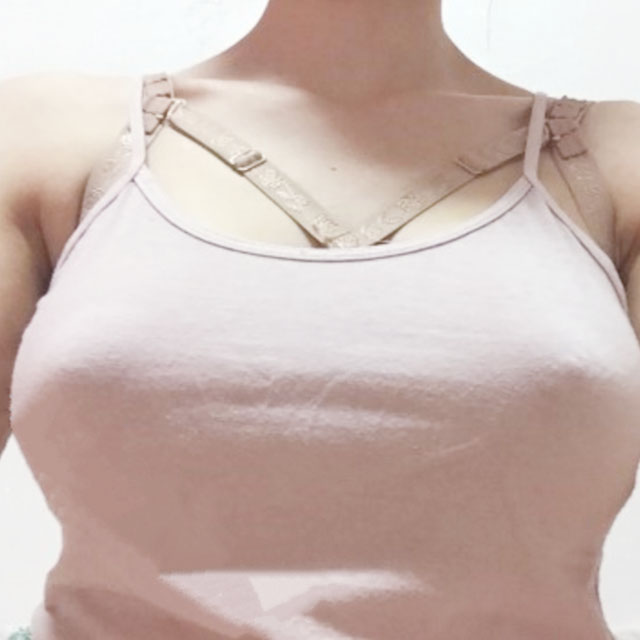 分享我自體脂肪隆胸手術(shù)的經(jīng)歷，還有前后對(duì)比果照片哦~