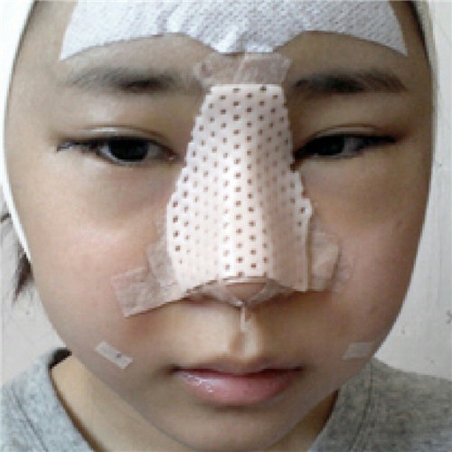 北京柏麗李勁良做的隆鼻整形，分享術(shù)后恢復(fù)果照片~