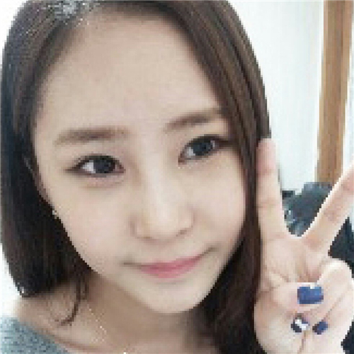 北京柏麗李勁良做的隆鼻整形，分享術(shù)后恢復(fù)果照片~