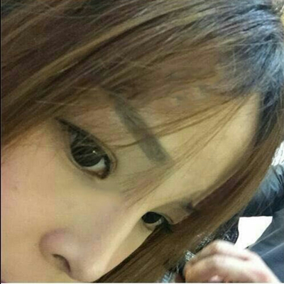 玻尿酸注射隆鼻三個(gè)月了，分享術(shù)后恢復(fù)照片哇~