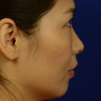 去醫(yī)院做了面部埋埋蛋白線.提升，肌膚緊致果不錯(cuò)