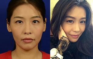 埋線蛋白提升前后對比圖