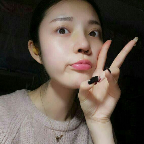 做了隆鼻整形手術(shù)好看多了，分享前后對(duì)比果照片~