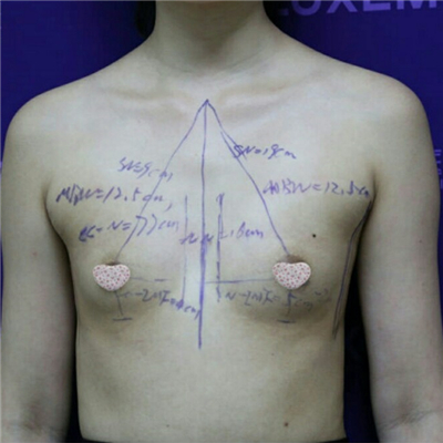 膨體假體隆胸手術(shù)過程分享，還有前后對比果照片哦~