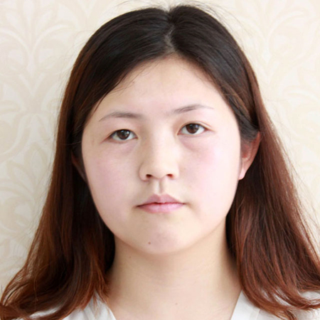 激光去雀斑前后對(duì)比果圖片分享，福州海峽林瓏醫(yī)生做的~