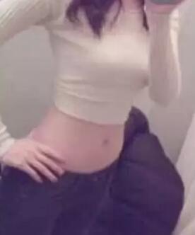 吸脂減肥手術(shù)3個多月了