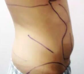 水動力吸脂減肥瘦腰腹，吸脂價格為11800元