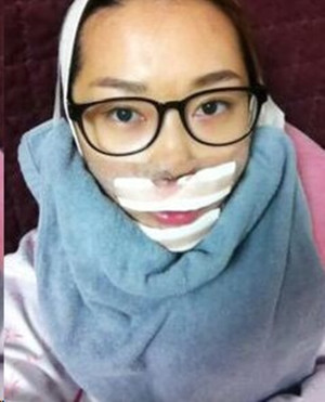 地包天手術(shù)前后過程以及對比照，真實案例分享