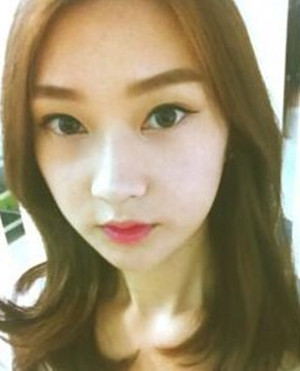 地包天手術(shù)前后過程以及對比照，真實案例分享