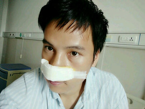 記錄了隆鼻整形（膨體隆鼻+鼻翼縮?。┦中g(shù)前后的過程，還有對比照片哦