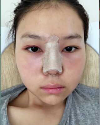 做隆鼻整形的親身日記，氣質(zhì)完全不一樣了