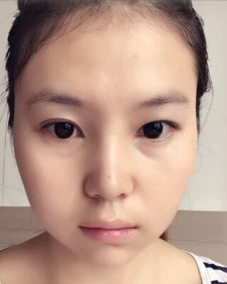 做隆鼻整形的親身日記，氣質(zhì)完全不一樣了