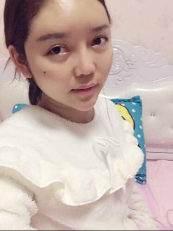 做了自體脂肪填充全臉果還不錯 現(xiàn)在請叫元氣少女