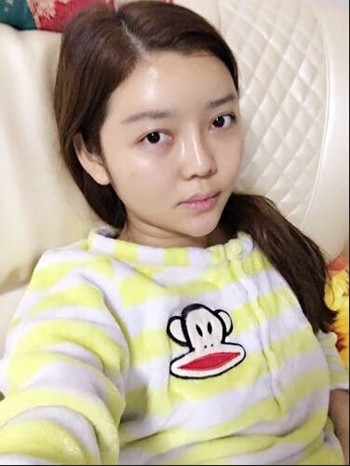 做了自體脂肪填充全臉果還不錯 現(xiàn)在請叫元氣少女