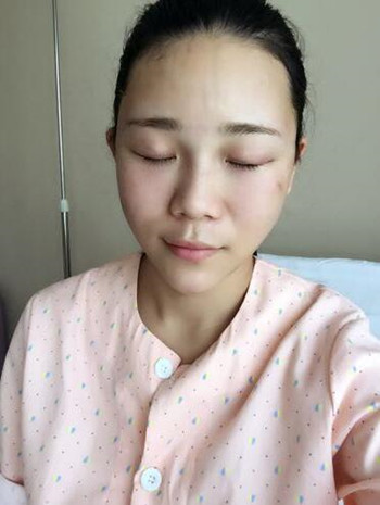 我的自體脂肪豐額頭+豐臉頰+雙眼皮+開眼角的真實經(jīng)歷 還有果圖哦