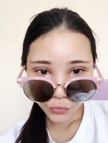 我的自體脂肪豐額頭+豐臉頰+雙眼皮+開眼角的真實經(jīng)歷 還有果圖哦