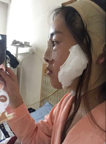 我在南昌佳美做的隆鼻整形+光纖溶脂去雙下巴 果真的很不錯