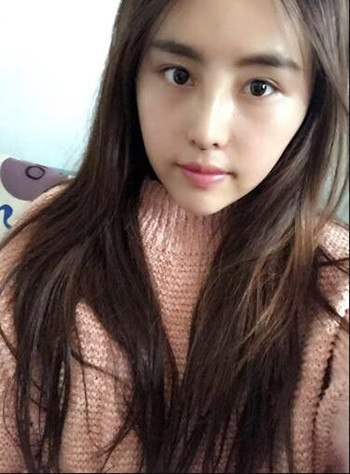 我在南昌佳美做的隆鼻整形+光纖溶脂去雙下巴 果真的很不錯