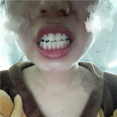 這個(gè)月在華西做了洗牙齒，果很好，分享恢復(fù)過程照片~