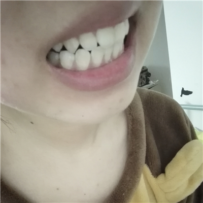 這個(gè)月在華西做了洗牙齒，果很好，分享恢復(fù)過程照片~