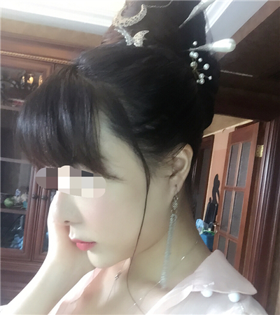 北京延世金慧燕做的果酸嫩膚，分享手術過程和前后對比果照片~