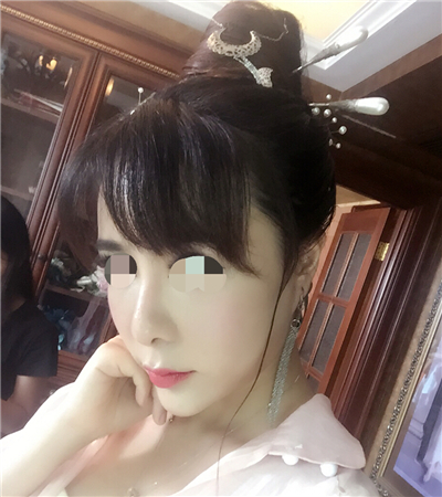 北京延世金慧燕做的果酸嫩膚，分享手術過程和前后對比果照片~