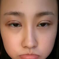 割雙眼皮恢復(fù)過程分享，整形價(jià)格3800元