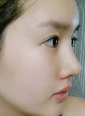 隆鼻術(shù)失敗修復(fù)整形術(shù)后果分享