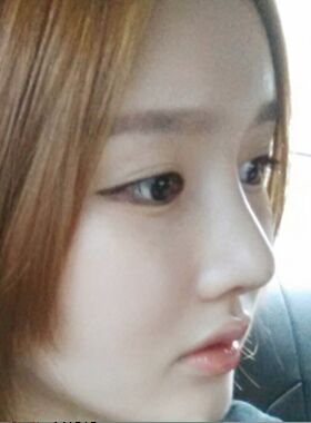 隆鼻術(shù)失敗修復(fù)整形術(shù)后果分享