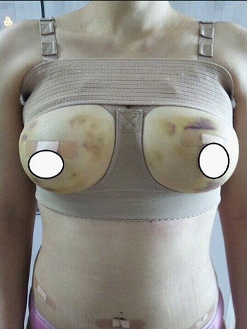 自體脂肪隆胸+腹部吸脂減肥恢復(fù)日記 內(nèi)有果對(duì)比圖