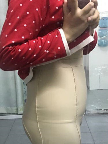 我的腰腹部吸脂減肥真實(shí)案例