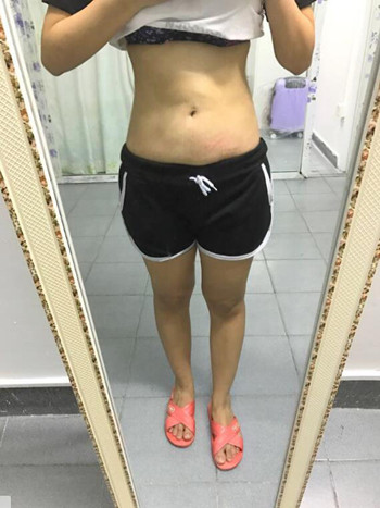 我的腰腹部吸脂減肥真實(shí)案例