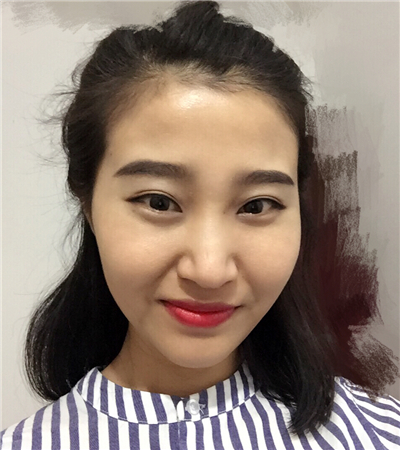 玻尿酸注射隆鼻前后對(duì)比果圖片分享，大同美神賈文醫(yī)生做的~