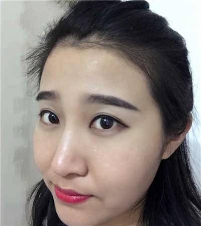 玻尿酸注射隆鼻前后對(duì)比果圖片分享，大同美神賈文醫(yī)生做的~