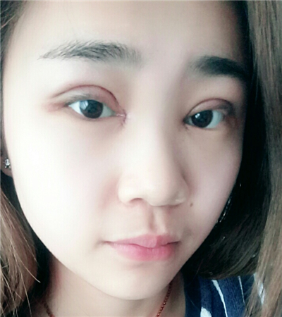 開(kāi)內(nèi)眼角+切開(kāi)雙眼皮前后對(duì)比果圖片分享，青島金島韓勝醫(yī)生做的~