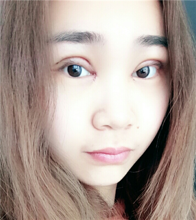 開(kāi)內(nèi)眼角+切開(kāi)雙眼皮前后對(duì)比果圖片分享，青島金島韓勝醫(yī)生做的~