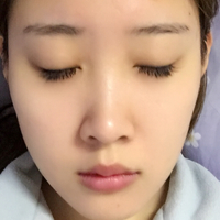 膨體隆鼻+墊鼻尖一個(gè)月時(shí)間的恢復(fù)過程