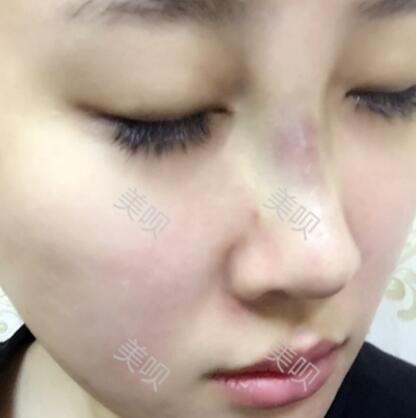 膨體隆鼻+墊鼻尖一個(gè)月時(shí)間的恢復(fù)過程