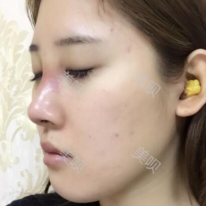 膨體隆鼻+墊鼻尖一個(gè)月時(shí)間的恢復(fù)過程