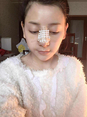 自體軟骨隆鼻手術(shù)前后過(guò)程以及對(duì)比照片分享