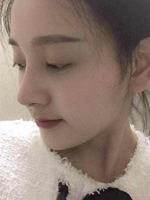 自體軟骨隆鼻手術(shù)前后過(guò)程以及對(duì)比照片分享