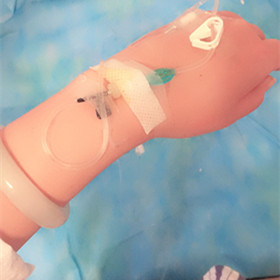 大腿抽脂手術(shù)后，還我小細(xì)腿!還有對(duì)比照片喲!