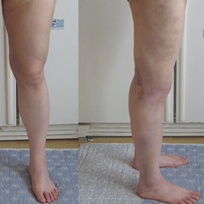 水動力吸脂瘦腰腹真實案例分享，還有前后對比果圖片哦~