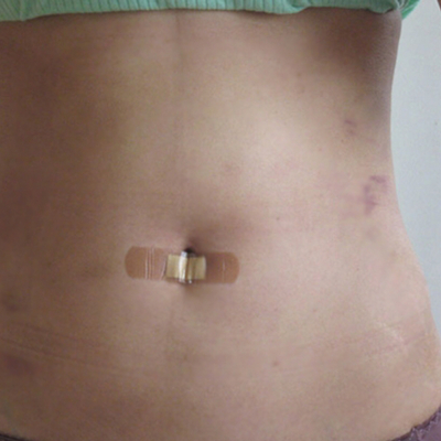 水動力吸脂瘦腰腹真實案例分享，還有前后對比果圖片哦~