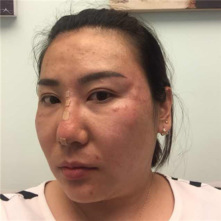 注射注射瘦臉去魚尾紋前后對比果照片分享，大同清木姜際珠做的~